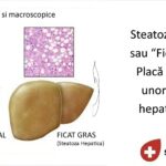 Despre osteoartrită