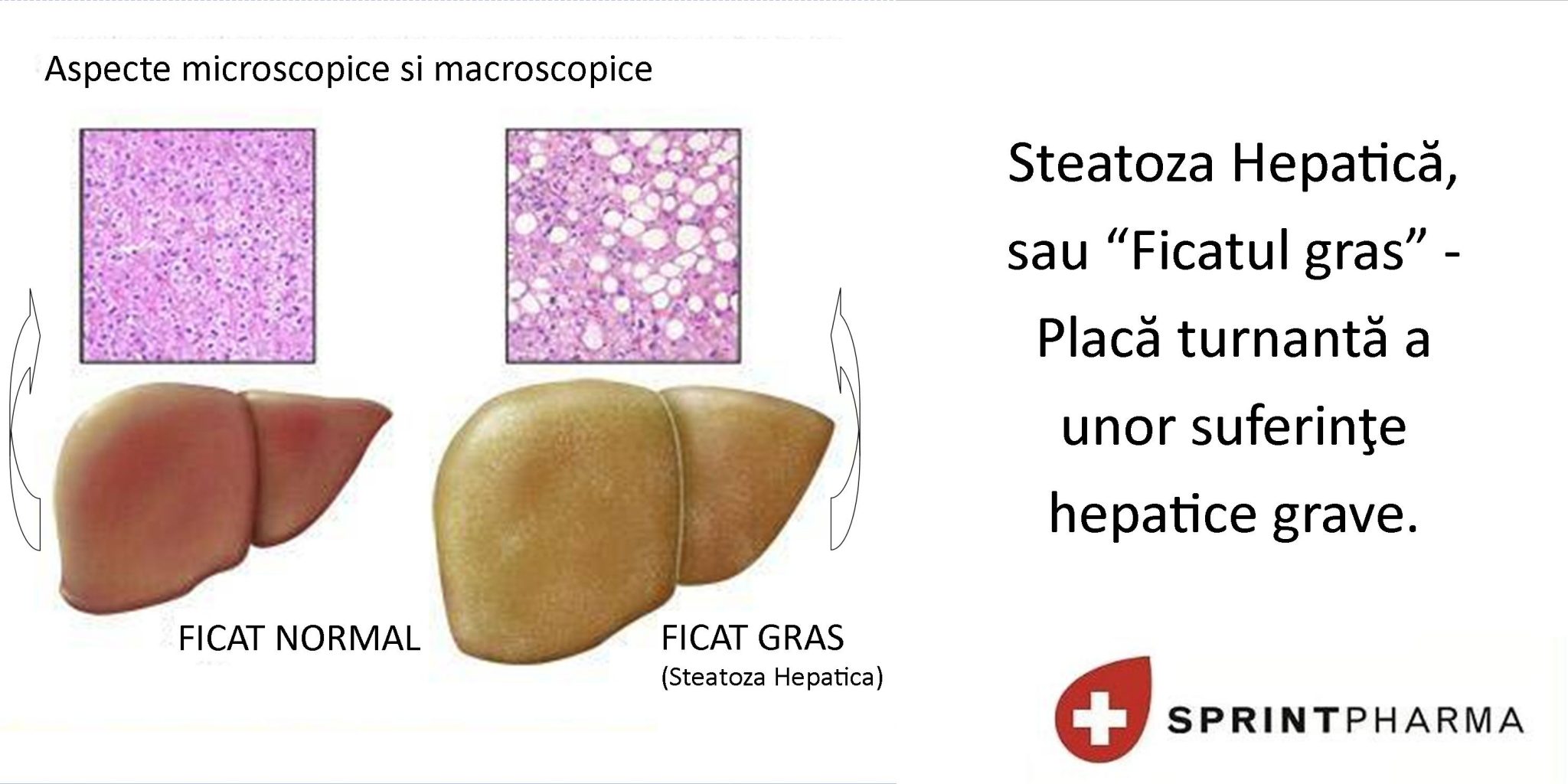 Steatoza hepatica – placa turnanta a unor suferinte hepatice grave